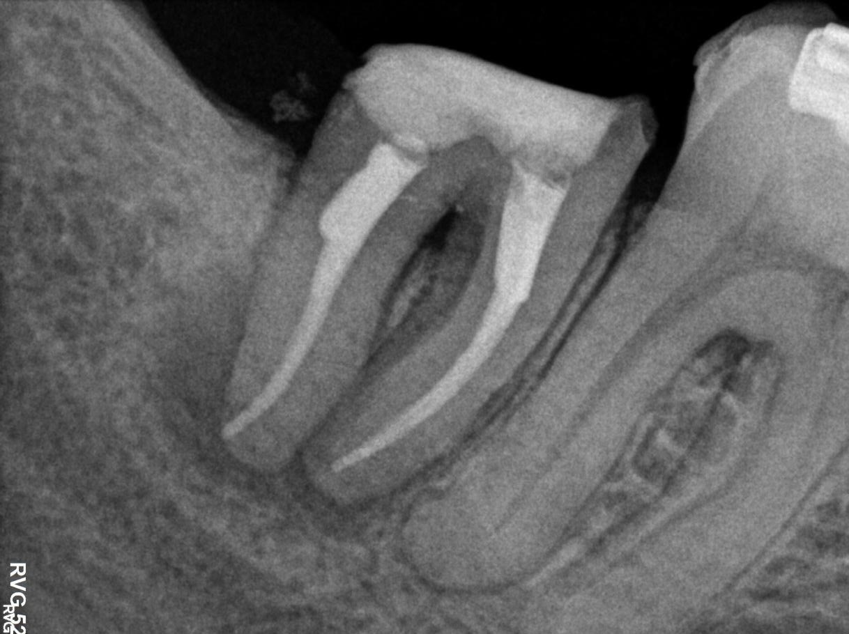 Radiografía después de un retratamiento de endodoncia